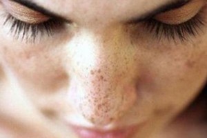 Cilt lekelerinden korkmayın, önlem alın