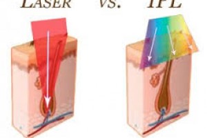 Diode Lazer & IPL Lazer Arasındaki Farklar