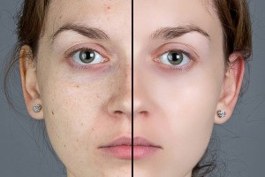 Kırışıklık, Leke, İz Tedavisinde ‘’Fraksiyonel Lazer’’?